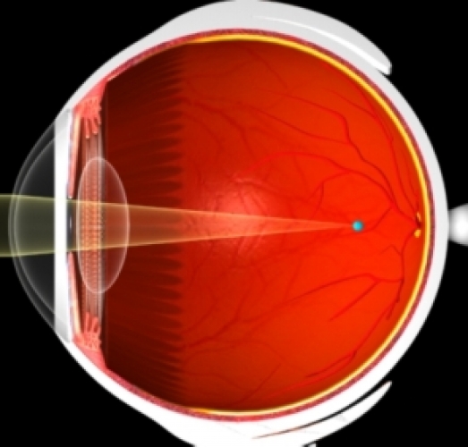 Миопия сетчатки. Миопия сетчатки глаза. Близорукий глаз. Близорукость и дальнозоркость. Дальнозоркость сетчатка.