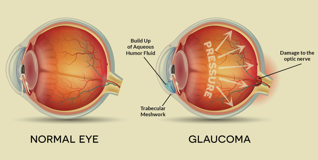 glaucom oftalmologic